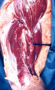 Natural color photograph of dissection of the arm and shoulder, lateral view