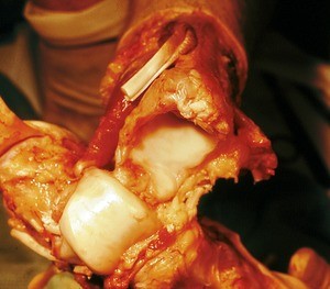 Natural color photograph of dissection of foot, showing disarticulated ankle joint