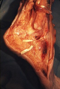 Natural color photograph of dissection of the right foot, lateral view, showing the cut ends of the peroneus longus t. (below) and peroneus brevis t. (above)