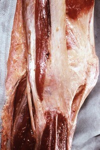 Natural color photograph of dissection of the right knee, lateral view, showing muscles, tendons and nerves