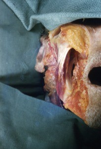 Natural color photograph of dissection of the face, anterior view, showing the right side of the mandible and associated structures