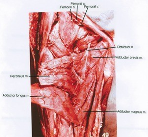 Natural color photograph of dissection of the right thigh, anterior view; the pectineus muscle has been cut and reflected to expose the obturator nerve of the surface of the adductor brevis muscle