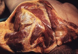 Natural color photograph of dissection of the right shoulder, superoposterior view, with the skin and trapezius muscle reflected to expose the underlying muscles of the back and shoulder