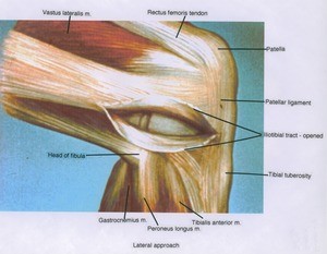 Illustration of right knee, lateral view, showing muscles, tendons, bones and ligament with the illiotibial tract opened
