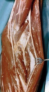 Natural color photograph of dissection of the left cubital fossa, anterior view, emphasizing the branching of the superficial and deep radial nerves