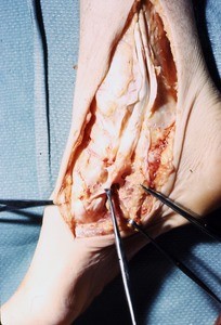 Natural color photograph of dissection of the right ankle, medial view