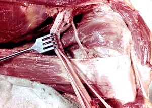 Natural color photograph of dissection of the left axilla, anterolateral view, emphasizing the axillary nerve, with the remaining branches of the brachial plexus retracted