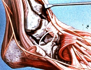 Illustration of structures of figure m522, right ankle emphasizing tarsal sinus