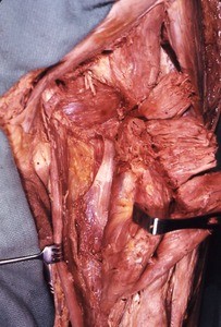 Natural color photograph of dissection of the left thigh, anterior view, showing the deep musculature