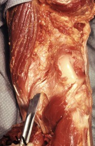 Natural color photograph of dissection of the popliteal fossa