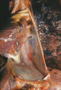 Natural color photograph of dissection of the thorax, anterior view, showing the mediastinum, phrenic nerve, and left lung