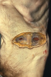 Natural color photograph of dissection of the left lower quadrant of the abdomen, anterior view, showing the tissue layers of the abdomen to the level of the rectus abdominus and external oblique muscle