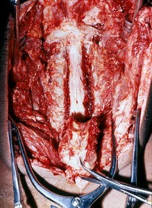 Natural color photograph of dissection of the spinal cord, posterior view