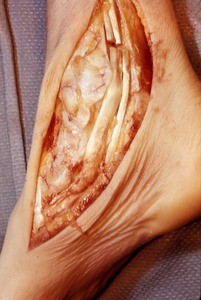 Natural color photograph of dissection of the right ankle, medial view, with the tibialis posterior t. and the flexor digitorum longus t. cut