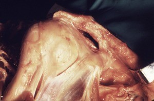 Natural color photograph of dissection of the right shoulder, anterior view, with the skin and muscles removed to reveal the tendons and ligaments associated with the glenohumeral joint