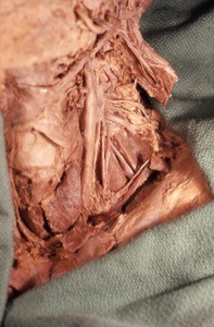 Natural color photograph of dissection of the left side of the neck, anterior view, with the sternocleidomastoid muscle cut and removed to expose the left common carotid artery, scalene muscles, and nerves