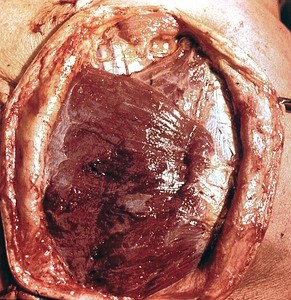 Natural color photograph of dissection of the left back, posterior view, with the skin retracted to expose the trapezius muscle