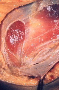 Natural color photograph of left inguinal region showing external oblique aponeurosis, superficial inguinal ring, rectus abdominis muscle and sheath, pyramidalis muscle