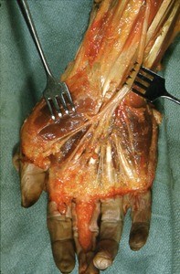 Natural color photograph of dissection of the right hand, anterior view, emphasizing the median nerve and its distal branches