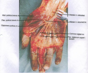 Natural color photograph of right hand and wrist, anterior view, showing muscles, tendons and nerves witht the median nerve retracted