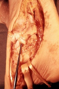 Natural color photograph of dissection of the right ankle, medial view, with the tibialis posterior t. and the flexor digitorum longus t. cut and reflected