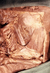 Natural color photograph of dissection of the neck, left lateral view