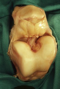 Natural color photograph of dissection of the knee, anterior view, showing the anterior cruciate ligament