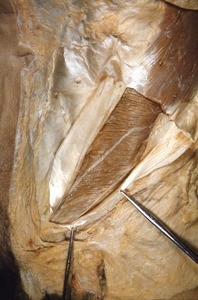 Natural color photograph of dissection of the abdominal wall, anterior view, showing the iliohypogastric n. (above) and the ilioinguinal n. (below) exiting the internal abdominal oblique m