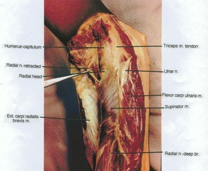 Natural color photograph of dissection of the left forearm, posterior view, showing extensor muscles and their innervation; the extensor digitorum muscle has been dissected away