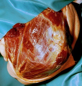 Natural color photograph of dissection of the left shoulder, superior view, with the skin reflected to expose the superficial muscles