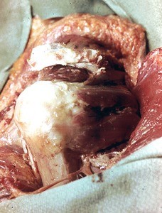 Natural color photograph of dissection of the left shoulder, posterolateral view, with the deltoid muscle reflected to expose the teres minor, infraspinatus, and supraspinatus muscles