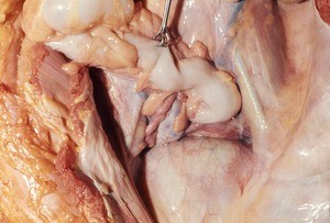 Natural color photograph of dissection of the pelvic cavity, superior view, with the sigmoid colon retracted to expose the uterus and bladder