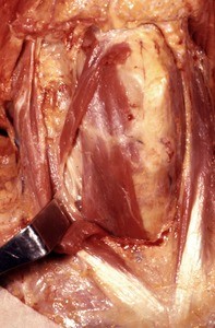 Natural color photograph of dissection of the neck, anterior view, with the sternocleidomastoid muscle retracted to expose the omohyoid, sternohyoid, and sternothyroid muscles