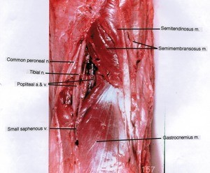 Natural color photograph of left knee, posterior view, showing muscles, vein, nerves and popliteal vessels