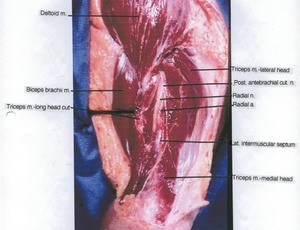 Natural color photograph of left arm, lateral view, showing muscles, artery and nerve