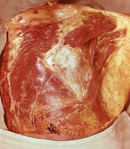 Natural color photograph of dissection of the back and right shoulder, posterior view, with the skin removed to show the superficial muscle structures