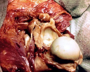 Natural color photograph of dissection of the left shoulder, lateral view, with the glenohumeral joint capsule opened and the head of the humerus dislocated from the supraglenoid tubercle