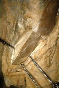 Natural color photograph of dissection of the left inguinal region, anterior view