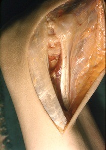 Natural color photograph of dissection of the left knee, lateral view