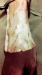 Natural color photograph of superficial dissection of the right wrist, posterolateral view