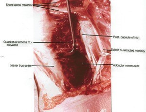 Natural color photograph of left hip, posterior view, showing muscles and bone with the sciatic nerve retracted