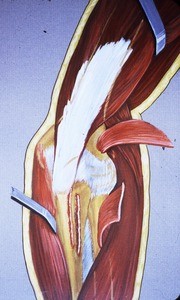 Illustration of right elbow, posterior view, with both anconeus m. and supinator m. cut and reflected; radial head is "ghosted in"