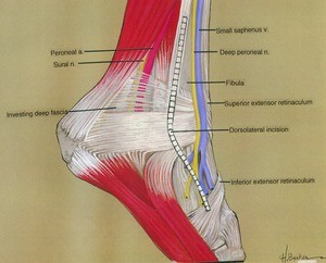 Illustration of dissection of the right ankle, dorsolateral view, emphasizing the ligaments