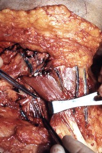 Natural color photograph of dissection of the neck, anterior view, with the right sternocleidomastoid muscle retracted to expose the inferior belly of the right omohyoid muscle