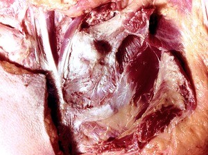 Natural color photograph of dissection of the thoracic wall, anterior view, showing the left clavicle and left pectoralis major m., which has been partially removed