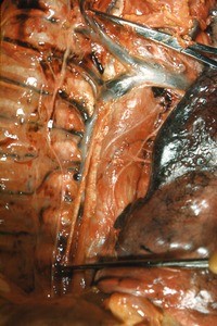 Natural color photograph of dissection of the right and medial thorax, anterior view, with the lung retracted medially to reveal the vasculature and nerves of the superior and posterior wall of the thorax