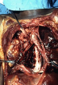 Natural color photograph of dissection of the thorax, anterior view, with the heart removed, aortic arch reflected, and esophagus reflected to expose the internal thoracic artery