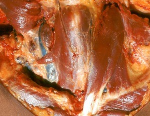 Natural color photograph of dissection of the neck, anterior view, with the right sternocleidomastoid m. cut and reflected