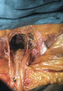 Natural color photograph of dissection of the pelvic cavity, superior view, with the sigmoid colon reflected forward to expose the sacrum and pelvic inlet