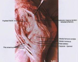 Natural color photograph of left knee, medial view, showing fascia, pes anserius, bones, ligament and opened capsule with Adductor magnus tendon retracted
